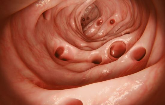 Divertikulose und Divertikulitis: Ursachen, Symptome und Behandlung